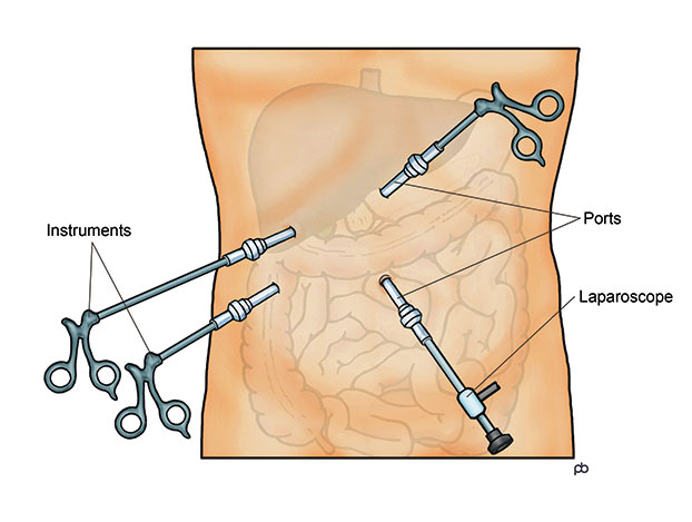KEYHOLE SURGERY
