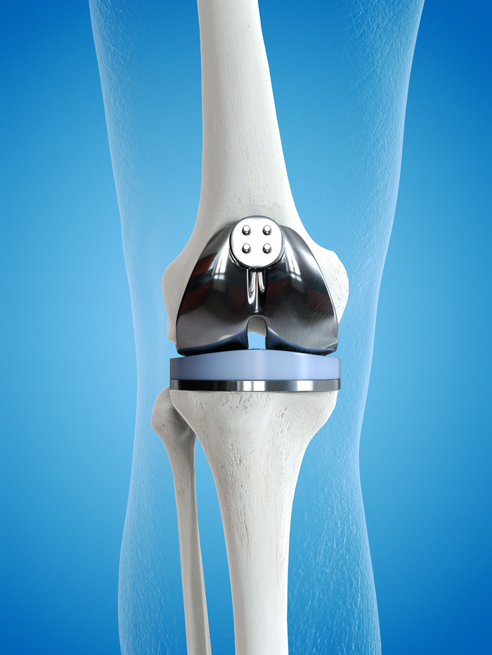 TOTAL KNEE REPLACEMENT