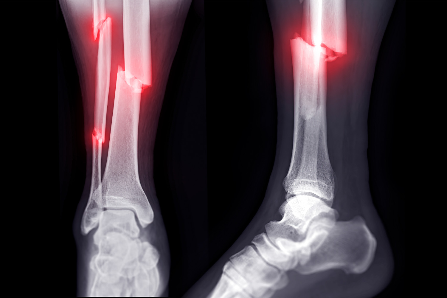 FRACTURE MANAGEMENT DOCTOR