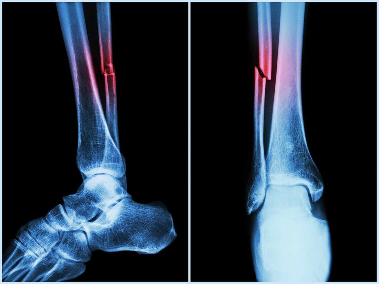 BEST FRACTURE SURGERY