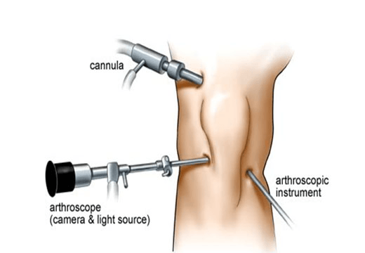 ARTHROSCOPY SURGERY