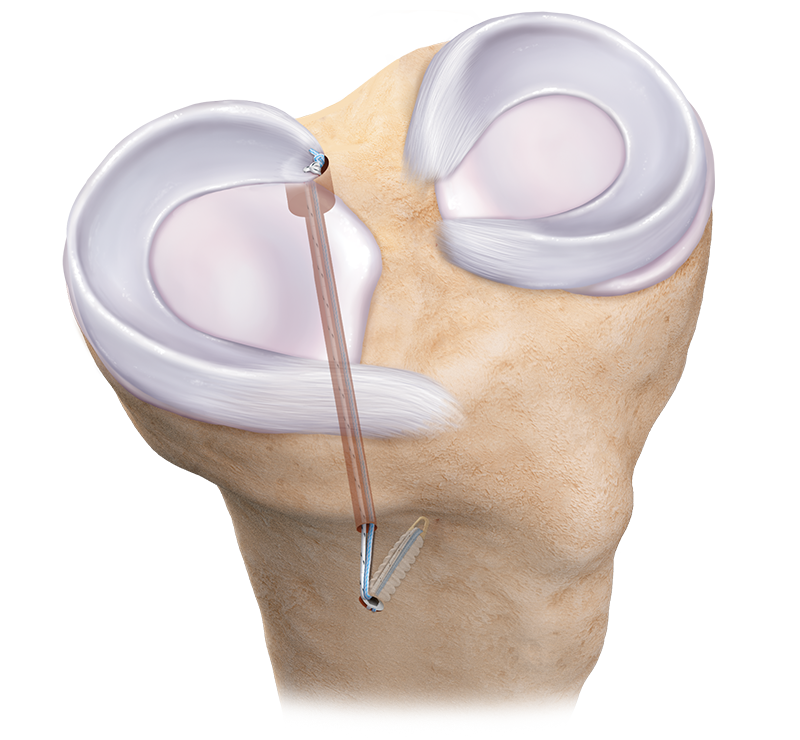 Meniscus Repair