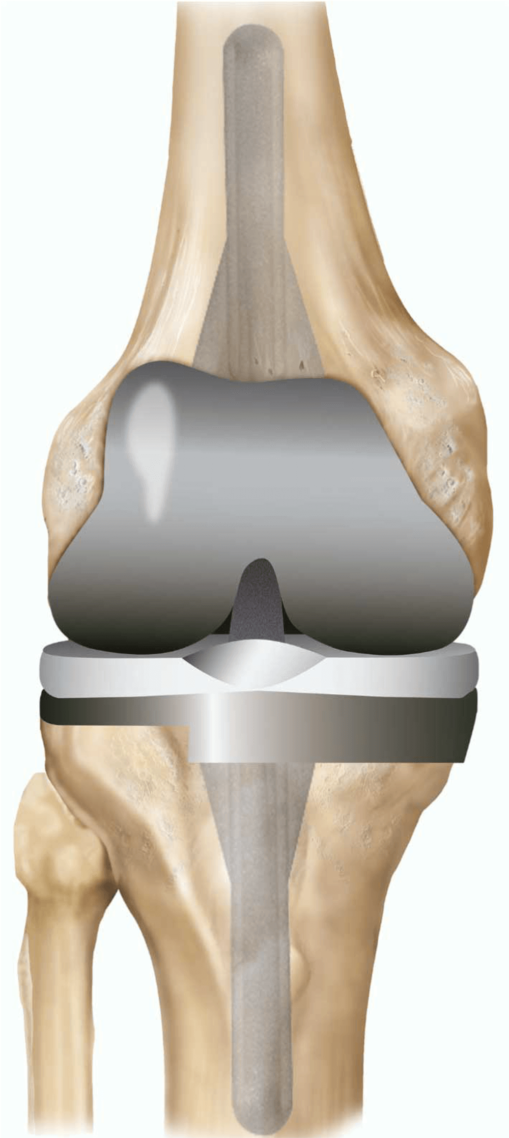 BEST KNEE REPLACEMENT SURGEON